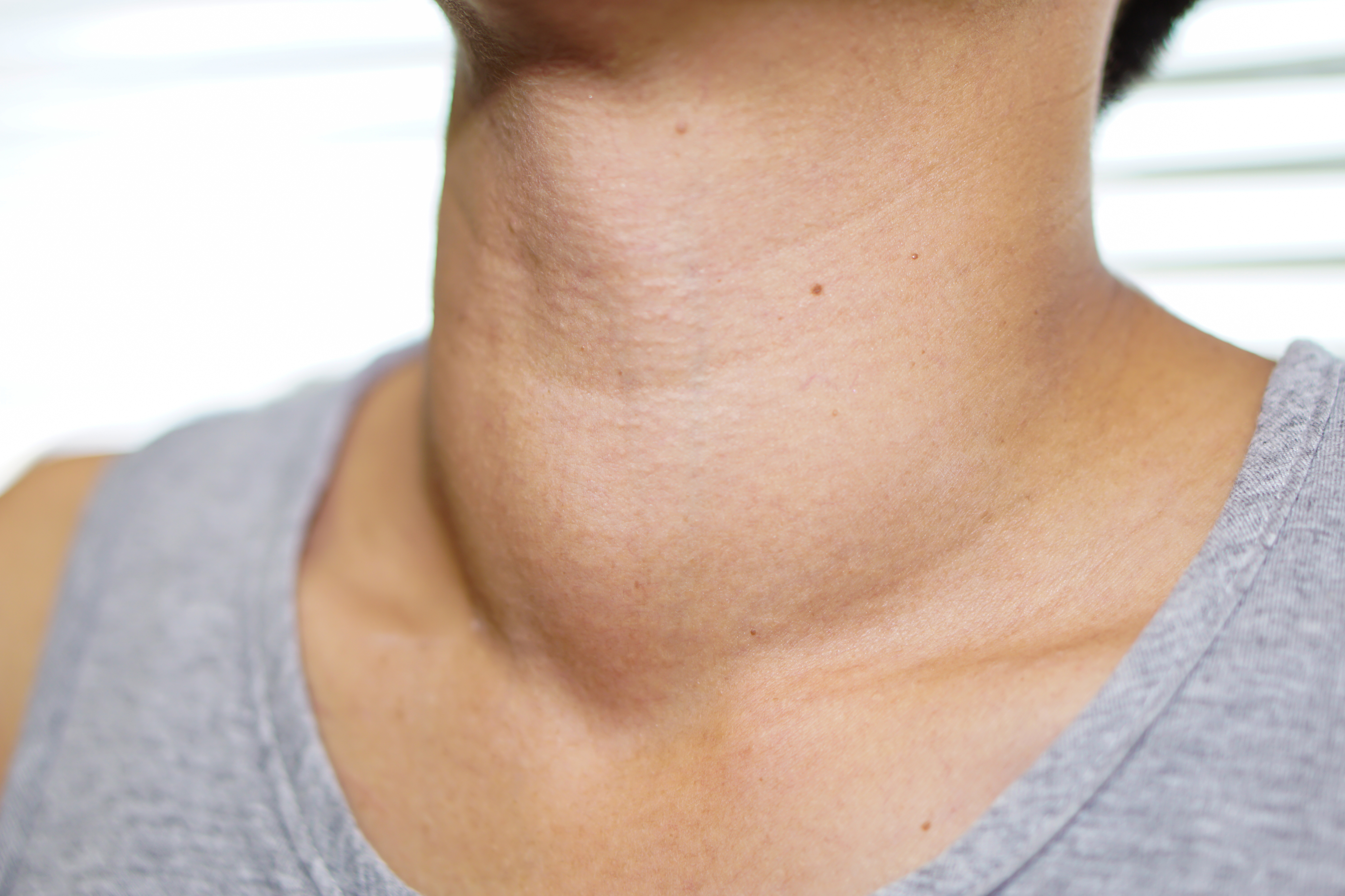 Thyroid Campaign